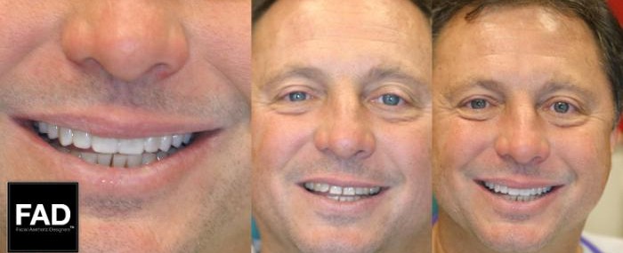 a man's before and after pictures of his smile